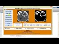 Matlab Code for Brain Tumor Detection and Classification
