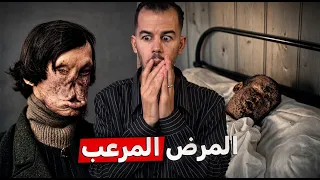 البرهارسيا  | مرض ينهش صحبه وهو حي