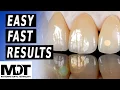 Download Lagu Aesthetic Results With E.max Micro Layering Techniques [ Easy, Fast Results ]