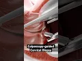 Download Lagu Het nemen van een monster uit de baarmoederhals (3D-animatie)