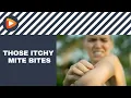 Are Itchy Mite Bites Bugging You Watch This
