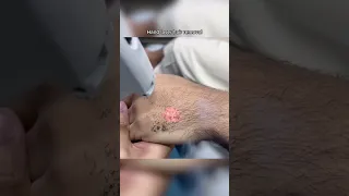 Dont Do This Ipl Laser Hair Removal 