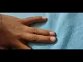 Lagu Syndactyly | Fused fingers