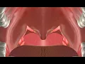 Lateral Pharyngoplasty for Sleep Apnea