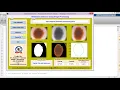Matlab Code for Skin Cancer Melanoma Detection Using Image Processing