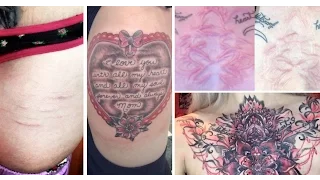 TATTOOING OVER SCARS