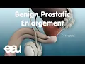 Benign Prostatic Enlargement BPE