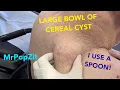 GIANT CYST removed with a spoon Tricky removal with heart condition and wheelchair but I get it done