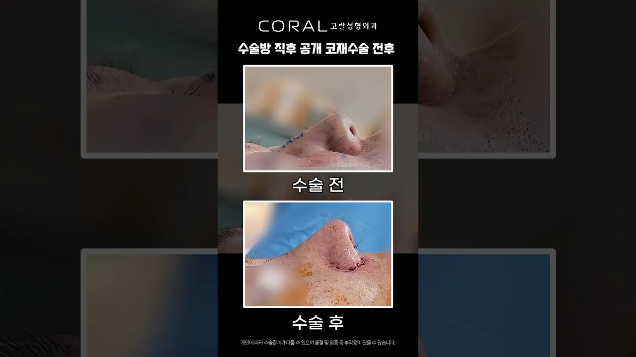 코끝 뭉툭함 싹 잡은 코재수술 레전드 비포애프터 #shorts #코재수술