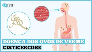 CISTICERCOSE: O QUE É, SINTOMAS, DIAGNÓSTICO, TRATAMENTO E PREVENÇÃO