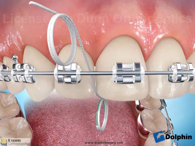 Flossing with Braces