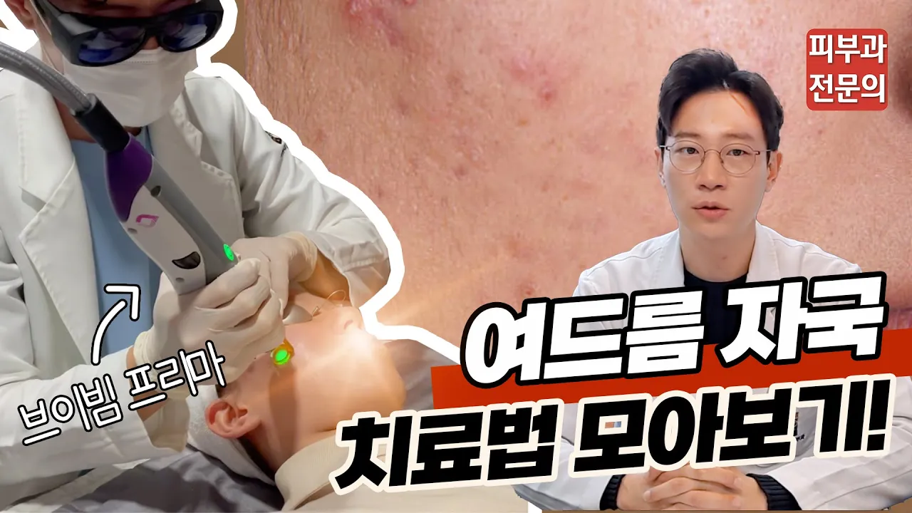 |여드름 자국 치료 프로그램| 울긋불긋 남은 '여드름 자국'의 효과적인 치료법 모아보기!