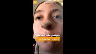 حديث السوشال عضة كلب تتسبب في نمو شعر على أنف فتاة  حديث السوشال عضة كلب تتسبب في نمو شعر على أنف فتاة