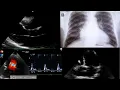 Download Lagu Advanced (stage D) heart Failure and Echocardiography:  A brief introduction