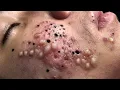 Blackheads Removal