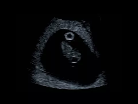 Download MP3 What Can You See At An 8 Week Baby Scan?