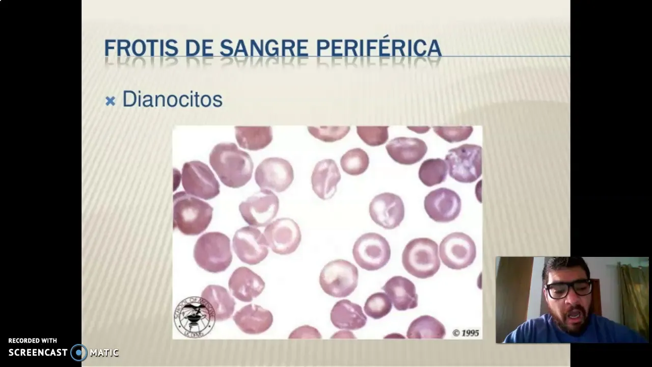 MORFOLOGIA ERITROCITARIA ANORMAL