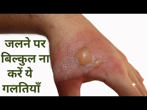 Download MP3 10 Home Remedies in Hindi to treat Skin Burn: जलने पर तुरंत अपनाएं ये घरेलू उपचार | Jeevan Kosh