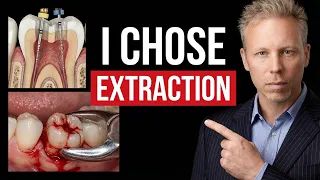 Root Canal vs Extraction? What Would a Dentist Choose for THEMSELVES?