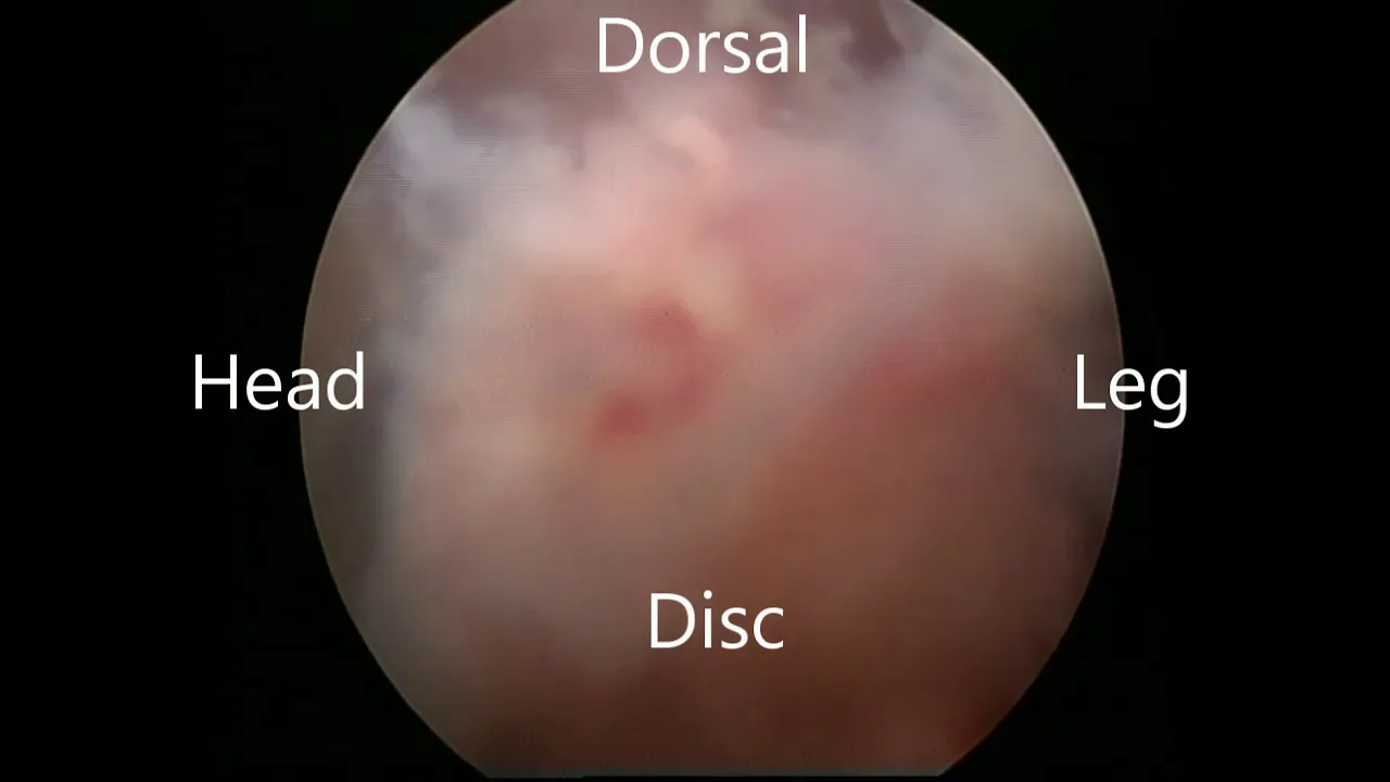 How to Help Your Herniated Disc Heal Quicker.  Disc Herniation Taping. 