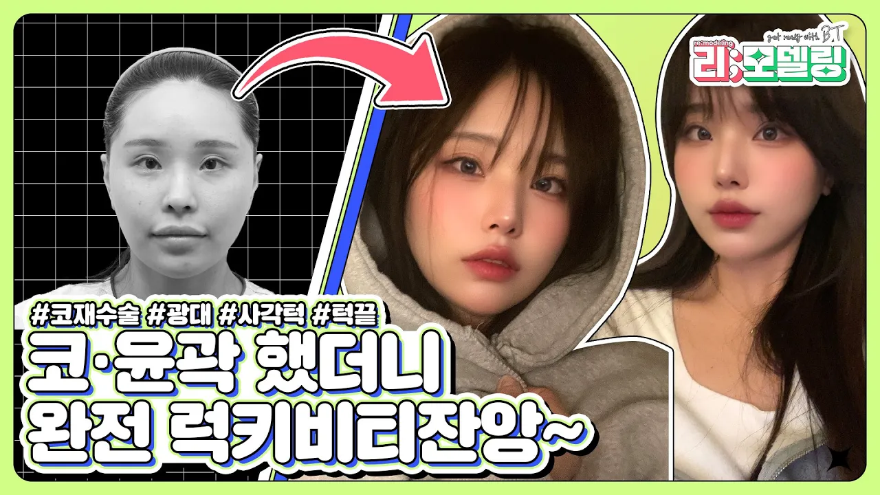 [비티성형외과 리얼스토리] 윤곽3종+코재수술 후기 VLOG