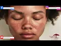 She Said It Was Lupus but what about her THYROID