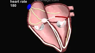 Wolff Parkinson White Syndrome Animation By Cal Shipley M D 