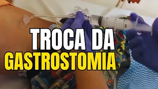 Sonda de Gastrostomia ou GTT: Troca passo a passo #gastronomia#nasctreinamentosenfermagem