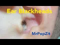 Ear Blackhead extractions Deep in the ear blackheads Quick extractions one dry one juicy MrPopZit