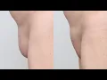 Mons Lipo ISCG