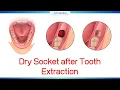 Dry socket after tooth extraction Oral Surgery