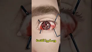 لازم تسوي كذا إذا تصبت فعينك Shortvideo 