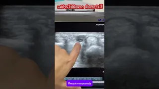 อาการชาที่ปลายนิ้วและมือซ้ายเกิดจากสาเหตุอะไร