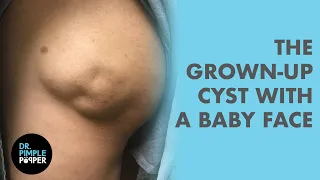 This Baby Face Cyst Startled Us vs. Dr. Pimple Popper