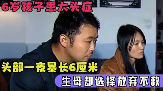 6岁孩子患大头症,头部一夜暴长6厘米,生母却选择放弃不救