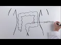 What is a sigmoidectomy