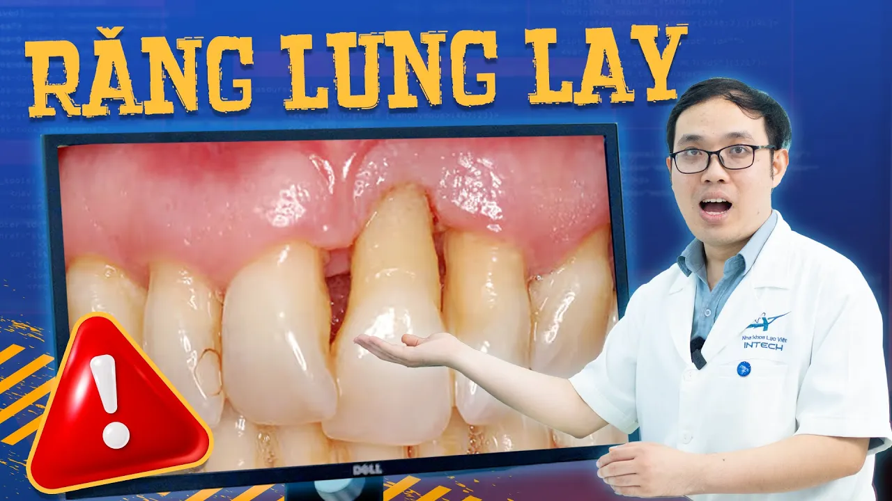 Outline Video Răng Lung Lay Làm Sao Cho Chắc Lại? 2 Cách Chữa Hiệu Quả Mà Không Cần Nhổ - Xem Ngay!