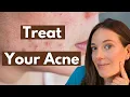 Acne Causes and Treatments Dermatology Advice