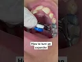 How to turn an RPE Rapid Palatal Expander for Orthodontic Treatment