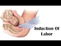 Induction Of Labor - Artificial Rupture Of Membranes Amniotomy