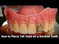 How to Place 14K Gold on a Denture Tooth