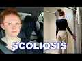 Download Lagu SCOLIOSIS CHECKUP