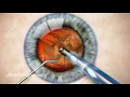 Phacoemulsification in Cataract Surgery