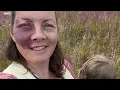 "I covered my birthmark for 34 years - but now I don't want to hide from my kids" | SWNS