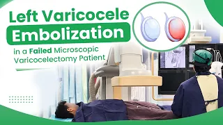 Left Varicocele Embolization in afailed microscopic varicocelectomy patient.