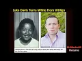 Download Lagu Michael Jackson's NOSE, White Skin, and Discoid Lupus! The TRUTH!