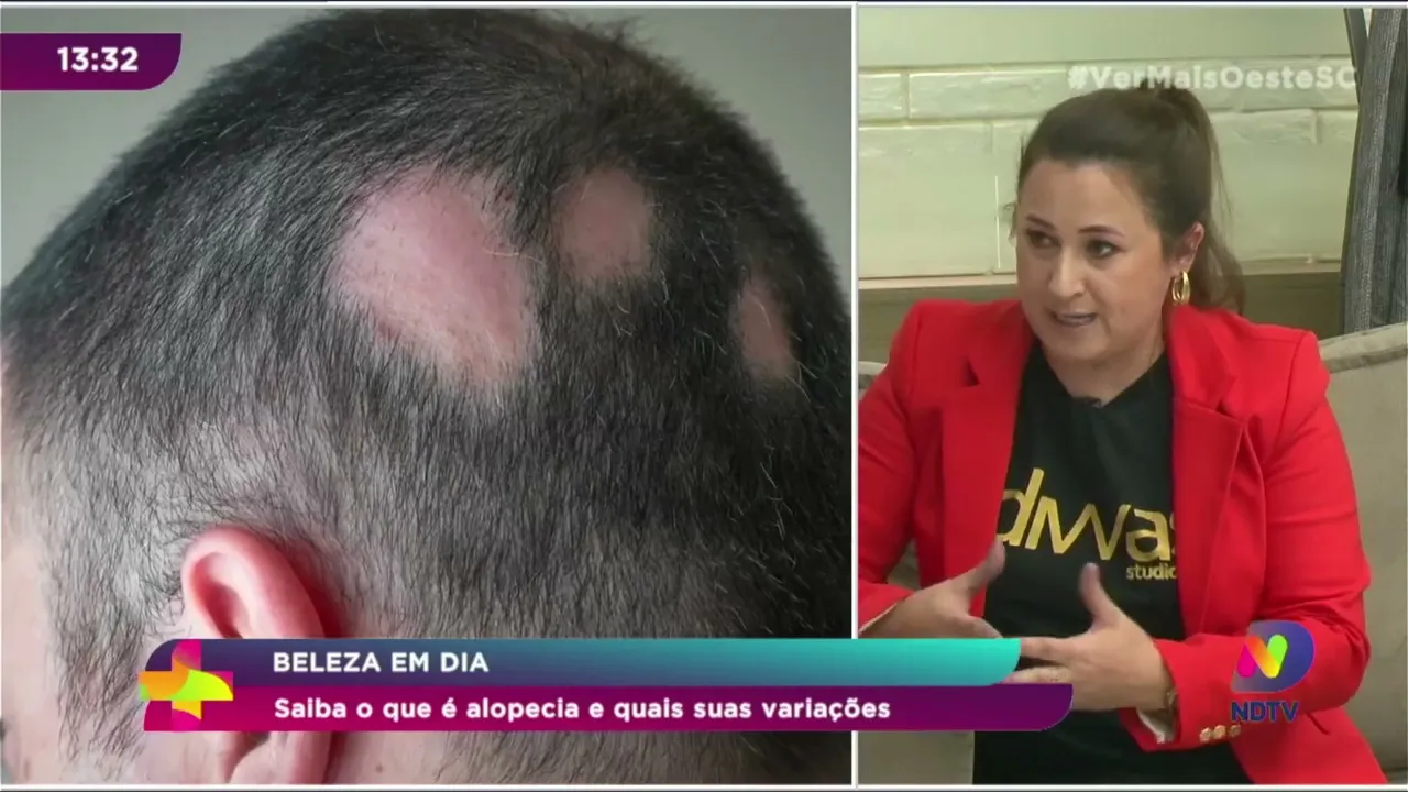 Beleza em Dia: saiba o que é alopecia e quais suas variações