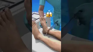 قاموا بعملية بتر لقدمه الخطأ حقائق اكسبلور الادوات 