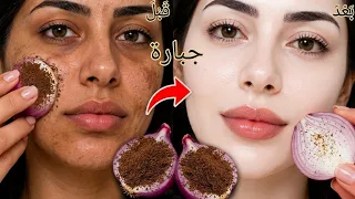 كيفية استخدام البصل🧅‼️ للتخلص من السواد نهائيا فى 15 دقيقة تبييض الوجه والجسم والمناطق الحساسة فوراً