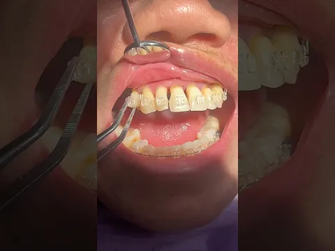 Braces + Loose Teeth: When Should You Worry?